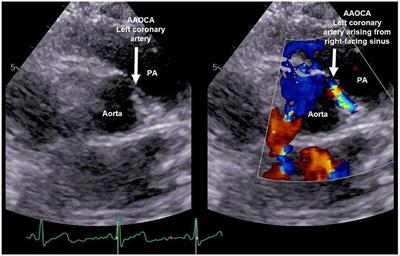 Symptomatic Coronary Anomalies and Ischemia in Teenagers – Rare but Real